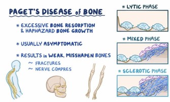 Pagets Disease Of Bone Causes Symptoms Treatment. iPharm